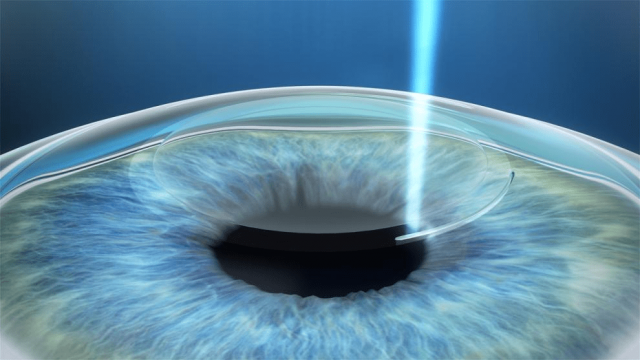 宜昌华厦近视手术专家胡学斌解答：为什么做近视手术要看角膜厚度